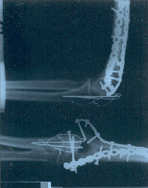 X ray of Jack's left arm showing the metal repair work