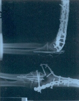 X-ray of Jack Gibbons' left arm, March 2001